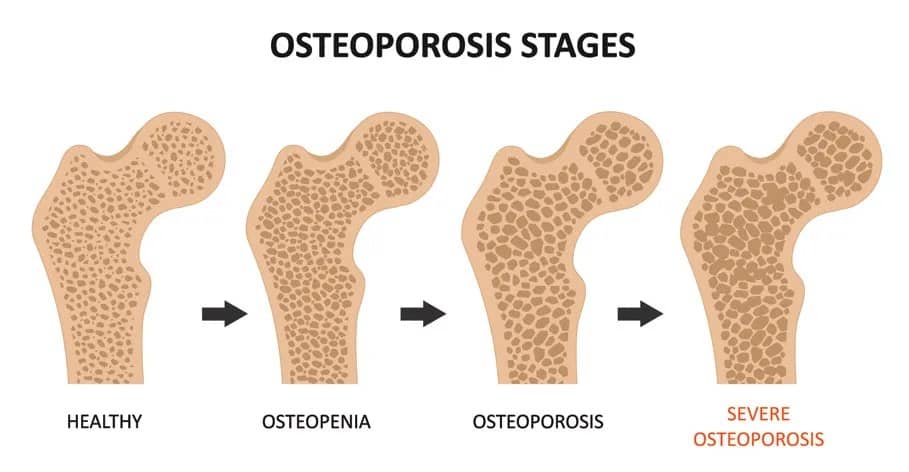 Example Of A Healthy Bone, Osteopenia And Osteoporosis, Showcasing The Loss Of Bone Integrity